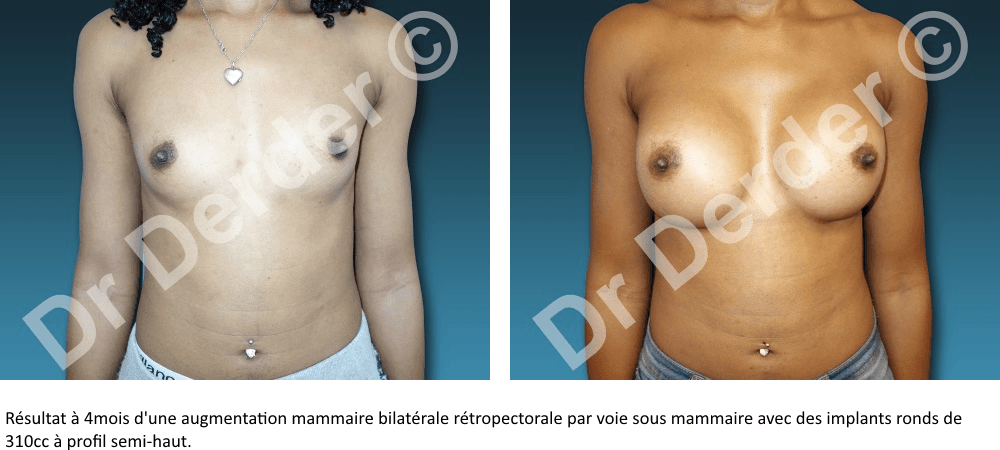 Résultat Augmentation mammaire — photographie avant et après