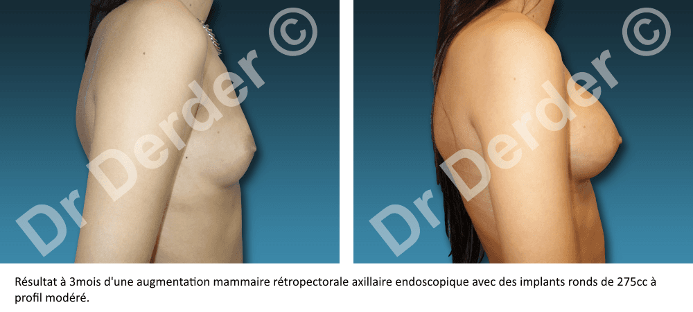Augmentation mammaire — résultat avant et après