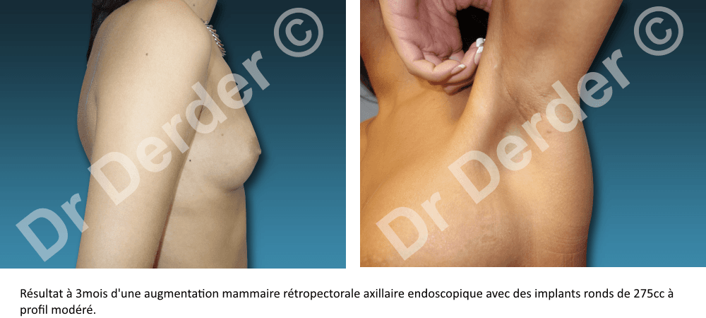 Augmentation mammaire — résultat avant et après