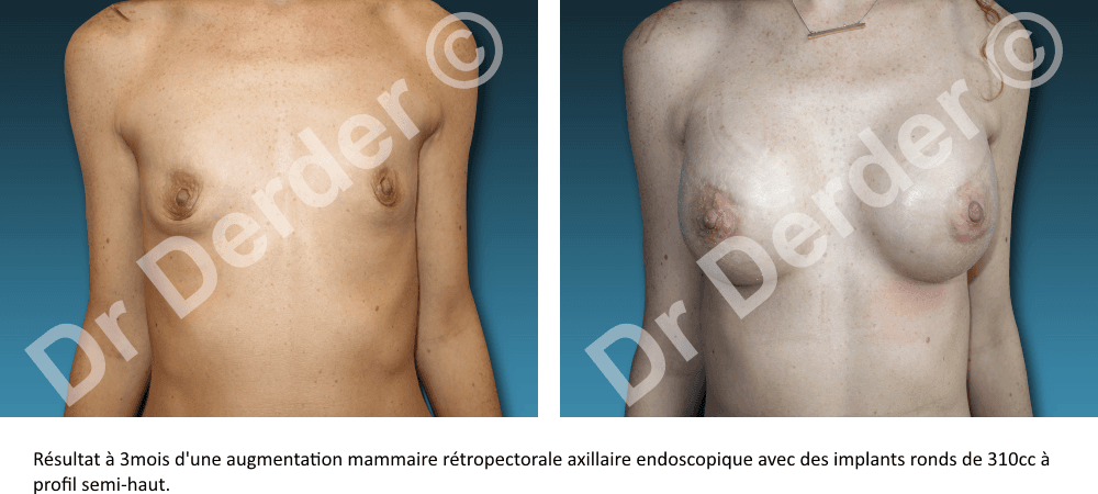 Augmentation mammaire — résultat avant et après
