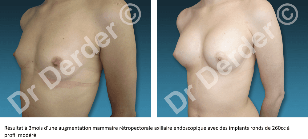 Augmentation mammaire — résultat avant et après