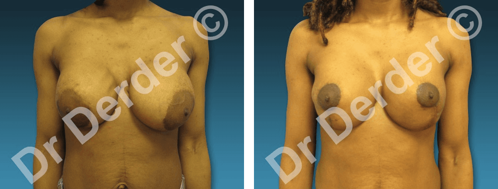 Résultat Chirurgie mammaire — photographie avant et après