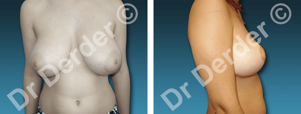 Chirurgie mammaire — résultat avant et après
