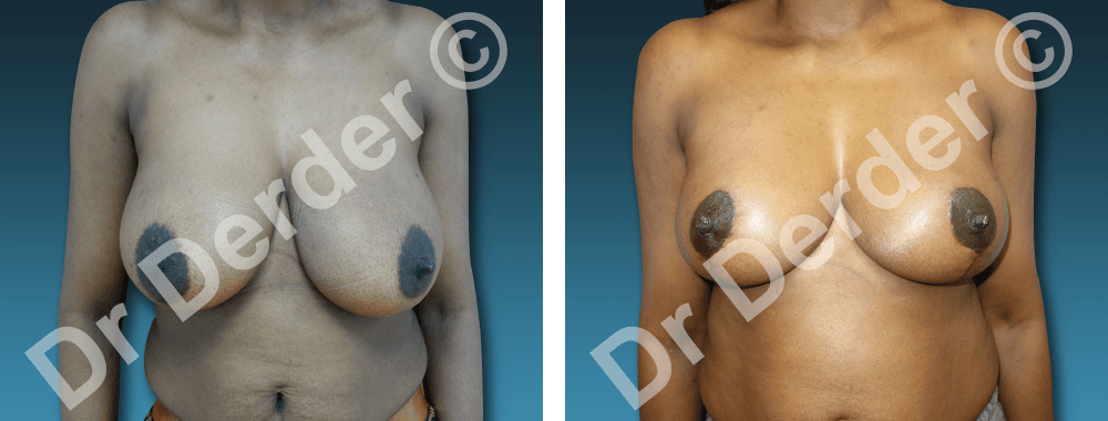 Chirurgie mammaire — résultat avant et après