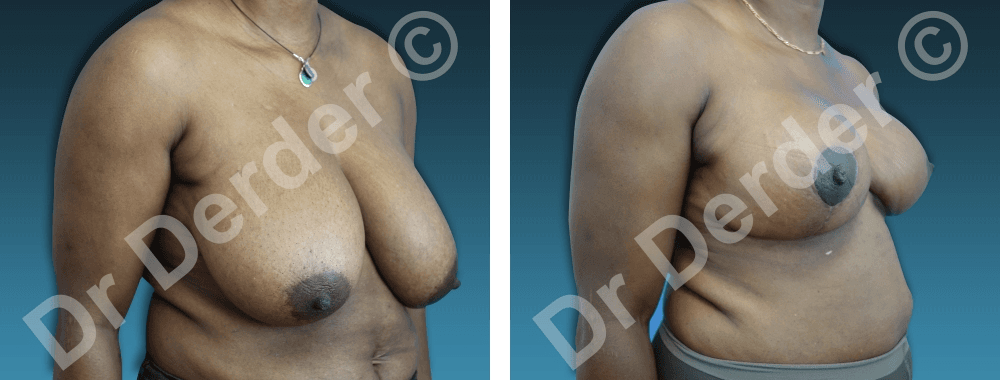 Chirurgie mammaire — résultat avant et après
