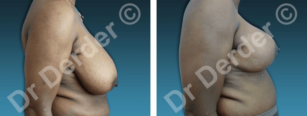 Chirurgie mammaire — résultat avant et après
