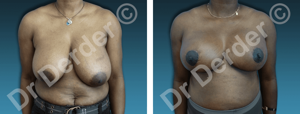 Chirurgie mammaire — résultat avant et après