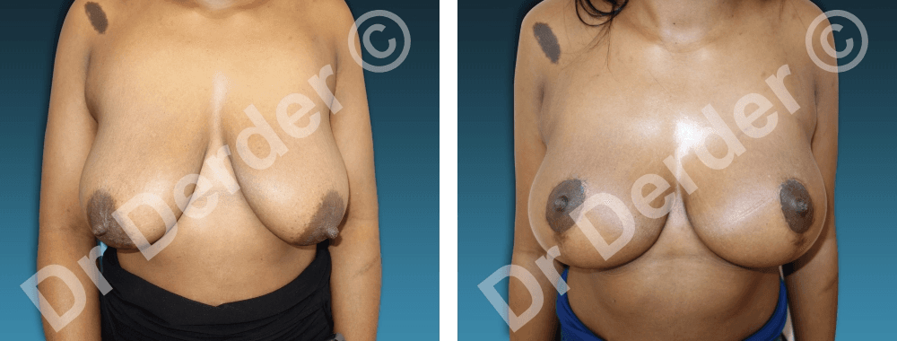 Chirurgie mammaire — résultat avant et après