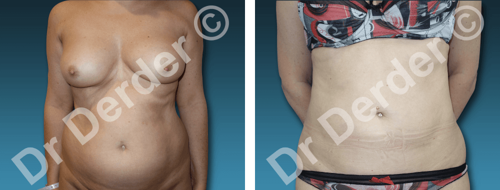 Résultat Lipoaspiration — photographie avant et après