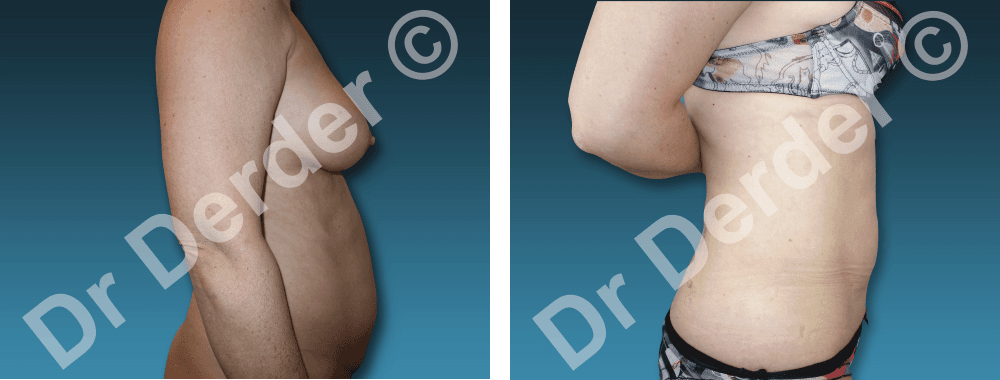 Lipoaspiration — résultat avant et après