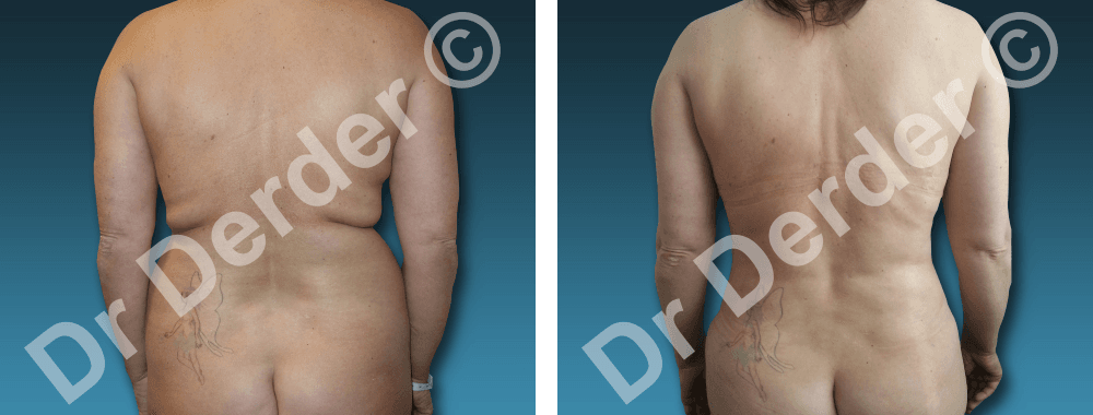 Lipoaspiration — résultat avant et après