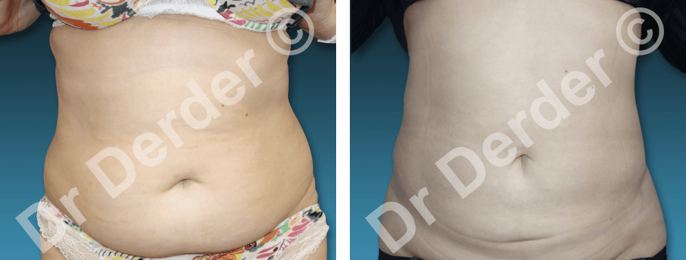Lipoaspiration — résultat avant et après
