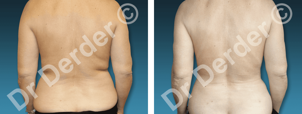 Lipoaspiration — résultat avant et après
