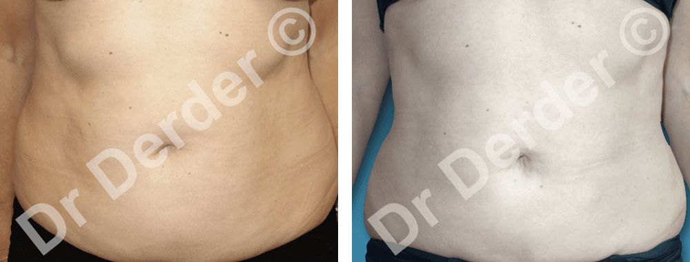 Lipoaspiration — résultat avant et après