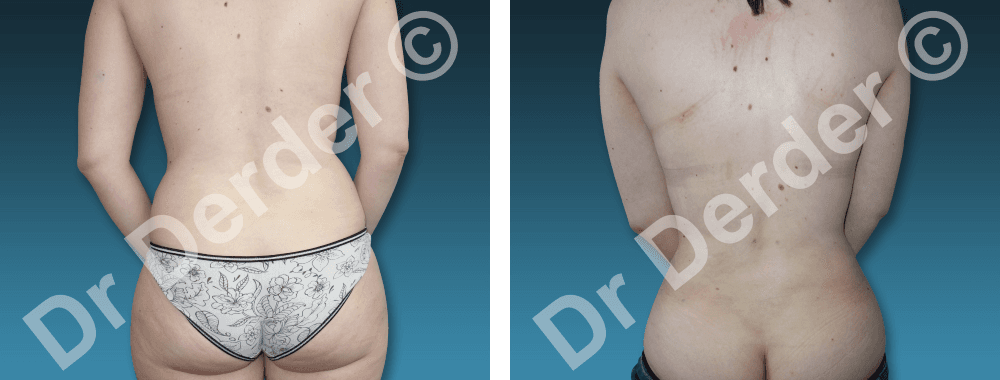 Lipoaspiration — résultat avant et après