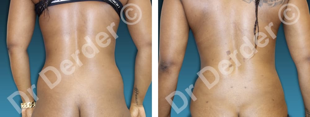 Lipoaspiration — résultat avant et après