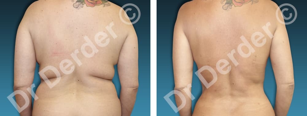 Lipoaspiration — résultat avant et après