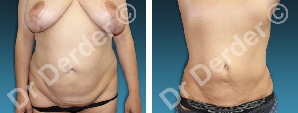 Lipoaspiration — résultat avant et après