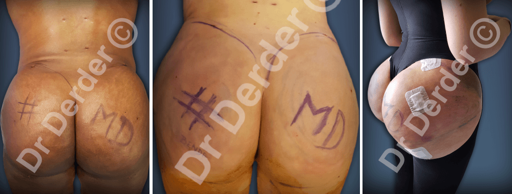 Lipofilling — résultat avant et après