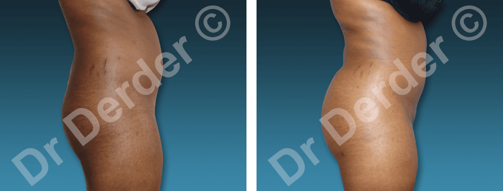 Lipofilling — résultat avant et après