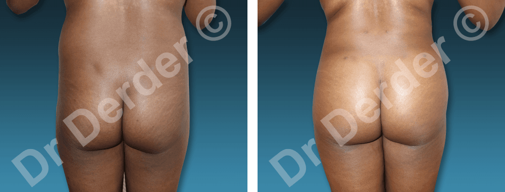 Lipofilling — résultat avant et après