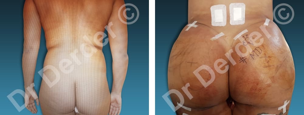 Lipofilling — résultat avant et après
