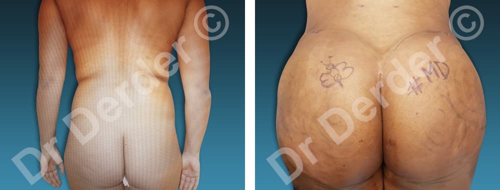 Lipofilling — résultat avant et après