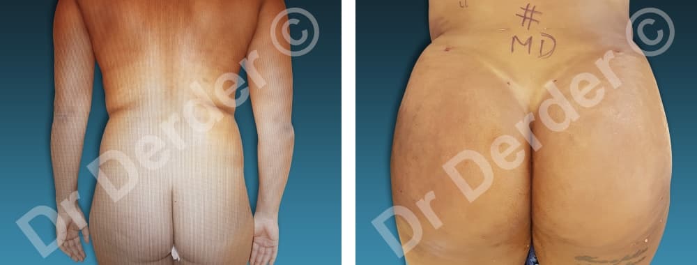 Lipofilling — résultat avant et après