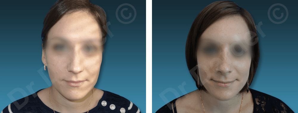 Résultat Rhinoplastie — photographie avant et après