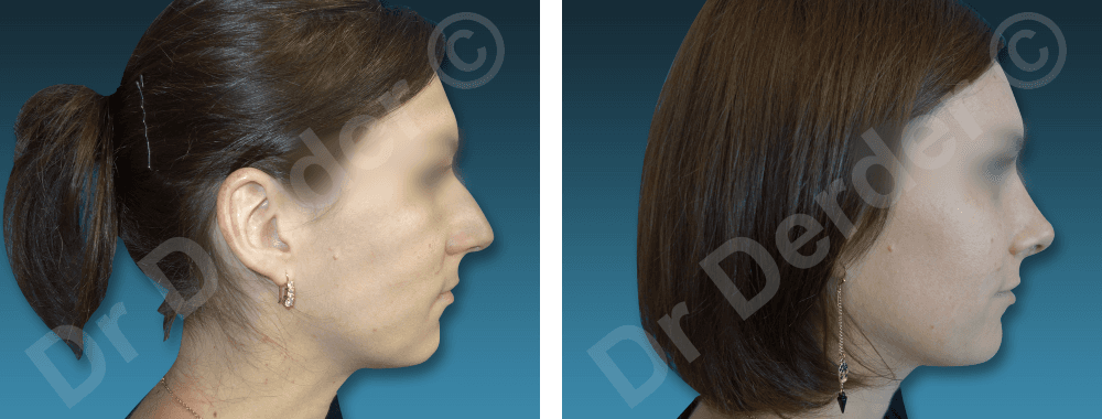 Rhinoplastie — résultat avant et après