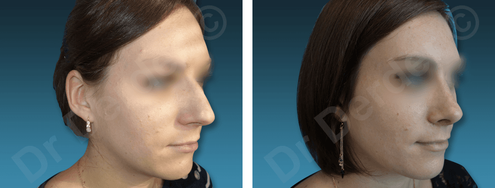 Rhinoplastie — résultat avant et après