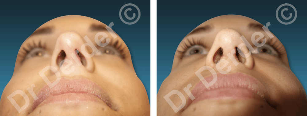 Rhinoplastie — résultat avant et après