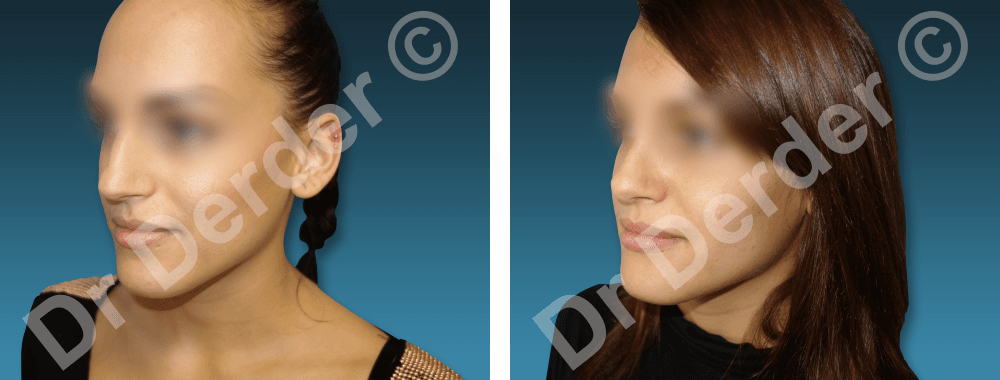 Rhinoplastie — résultat avant et après