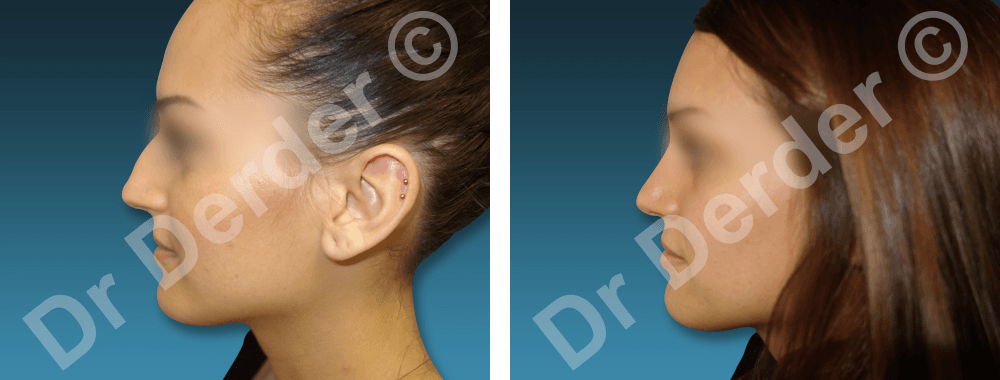 Rhinoplastie — résultat avant et après
