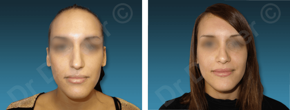 Rhinoplastie — résultat avant et après
