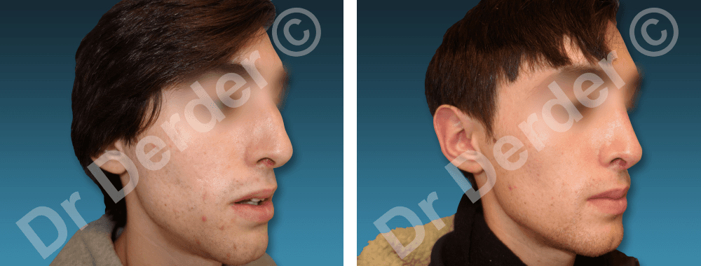 Rhinoplastie — résultat avant et après