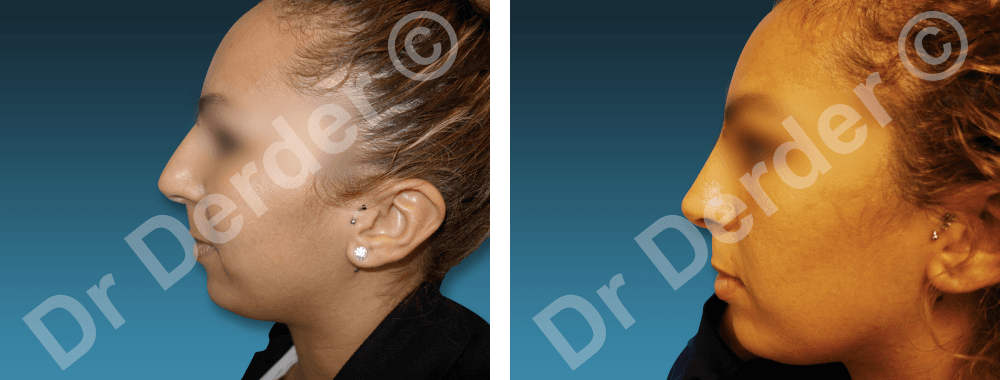 Rhinoplastie — résultat avant et après