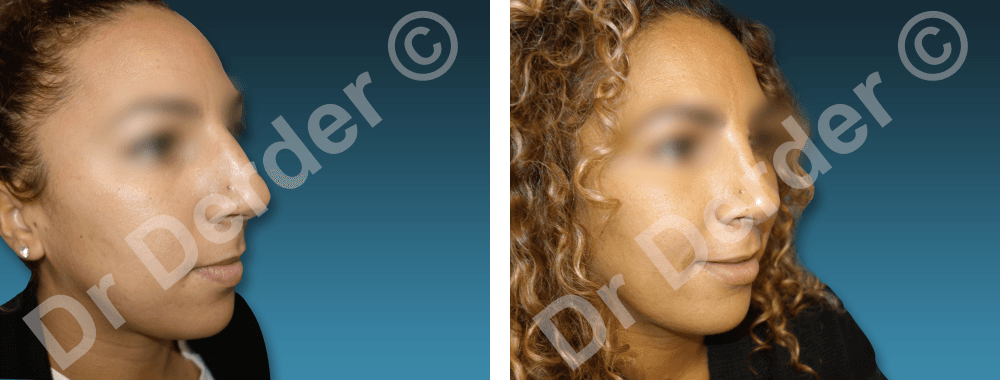Rhinoplastie — résultat avant et après