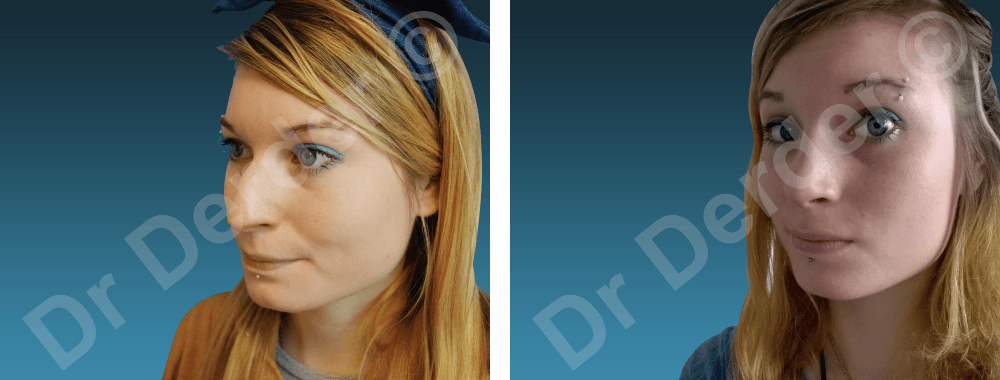 Rhinoplastie — résultat avant et après