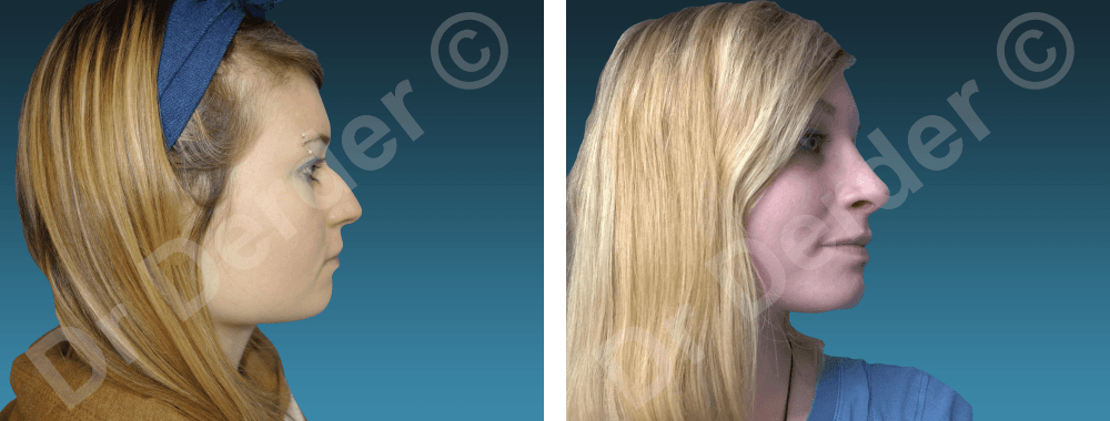 Rhinoplastie — résultat avant et après