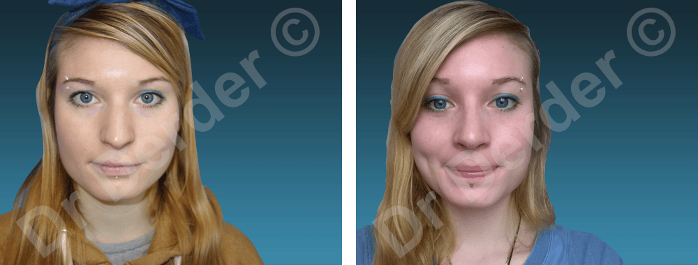 Rhinoplastie — résultat avant et après