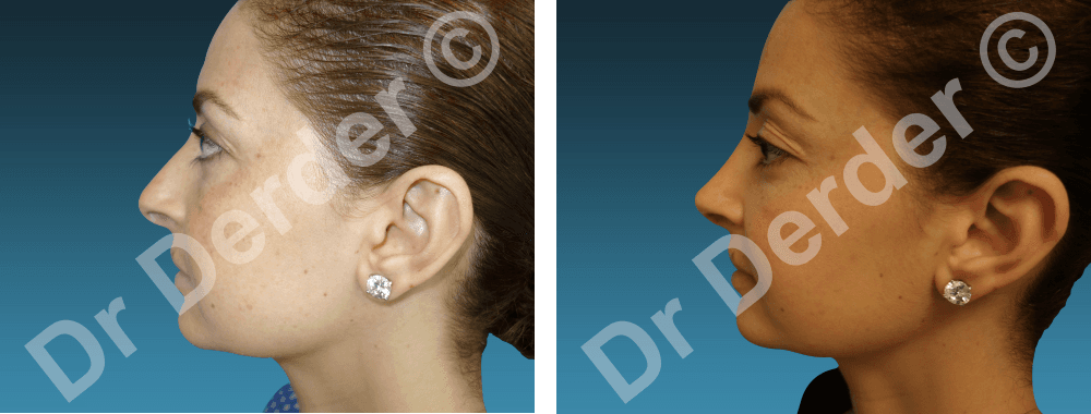 Rhinoplastie — résultat avant et après