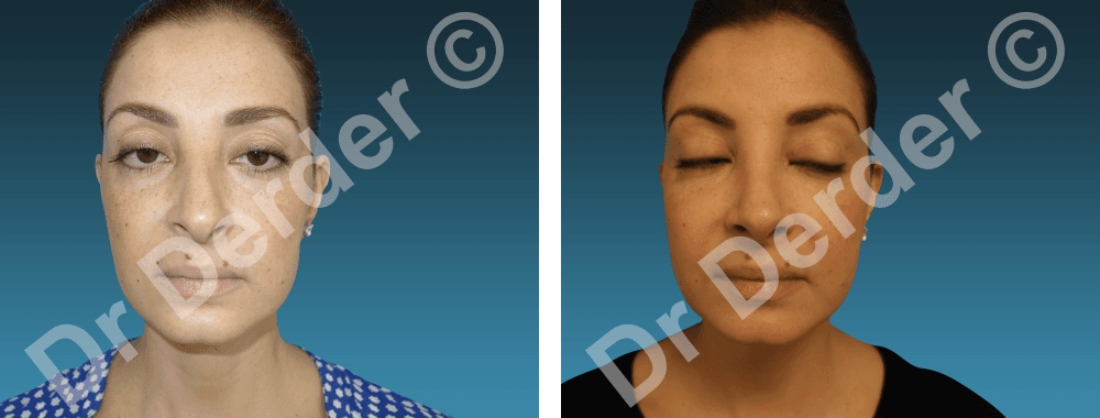 Rhinoplastie — résultat avant et après