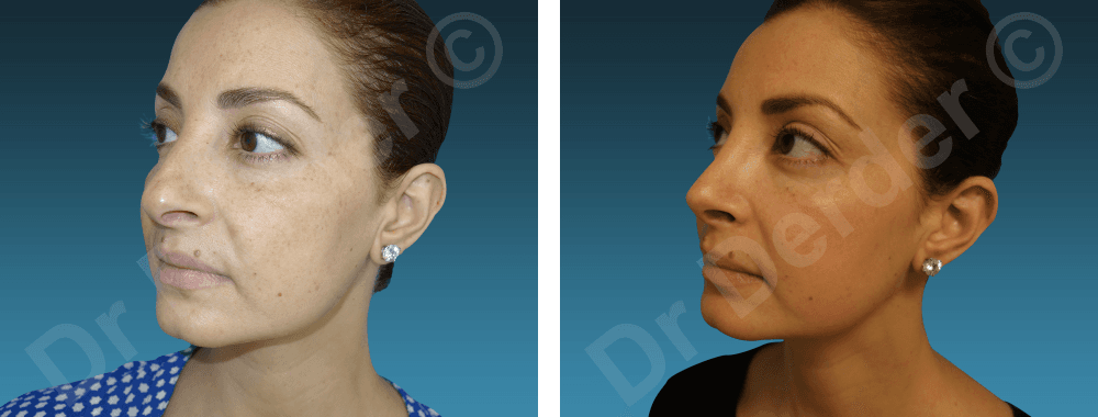 Rhinoplastie — résultat avant et après