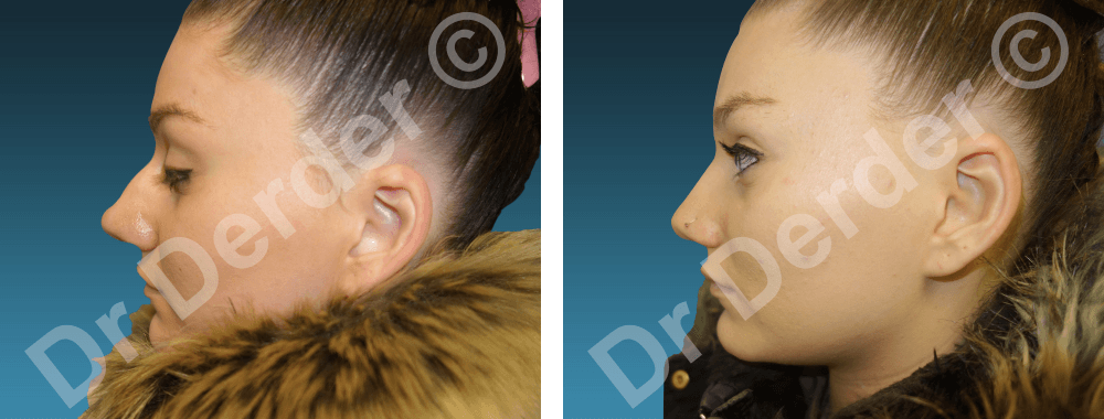 Rhinoplastie — résultat avant et après