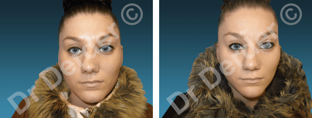 Rhinoplastie — résultat avant et après