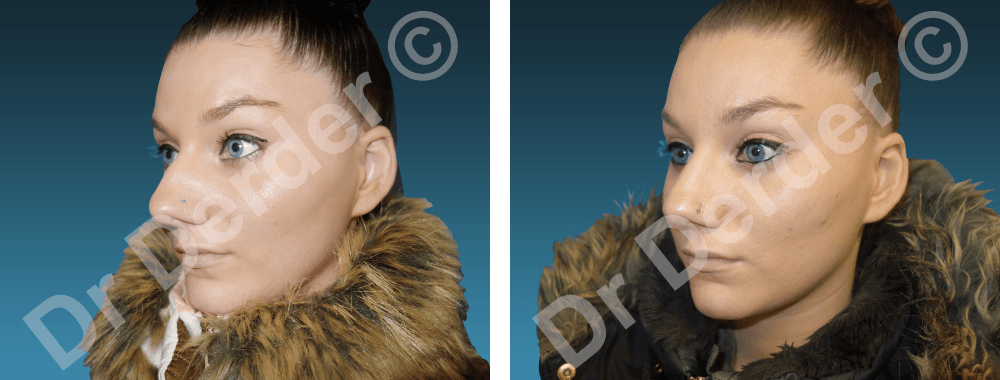 Rhinoplastie — résultat avant et après