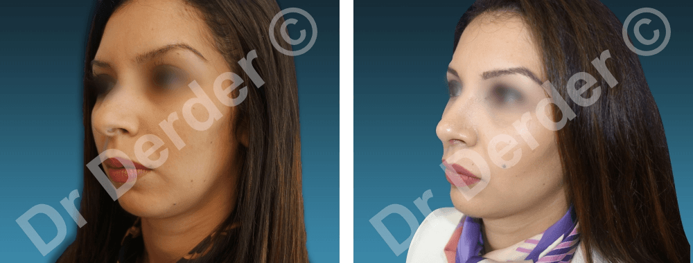 Rhinoplastie — résultat avant et après