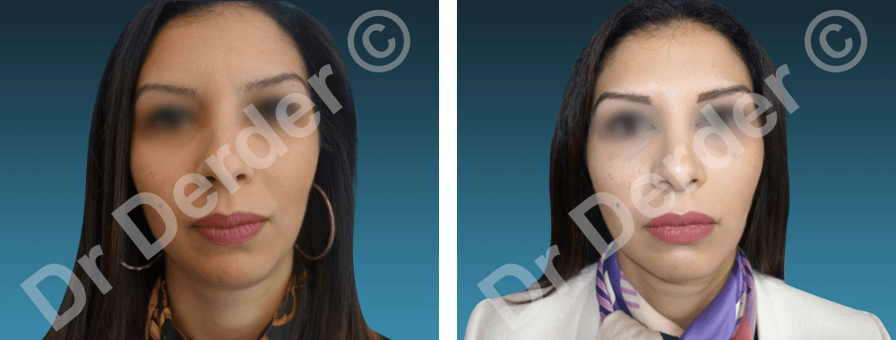 Rhinoplastie — résultat avant et après