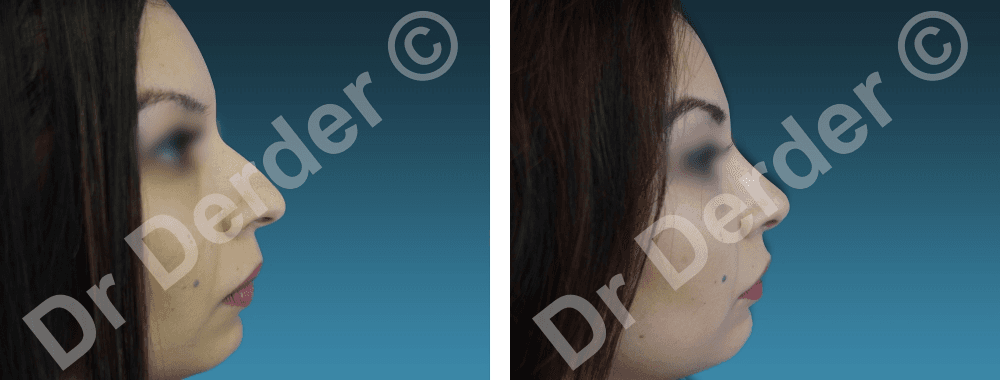 Rhinoplastie — résultat avant et après